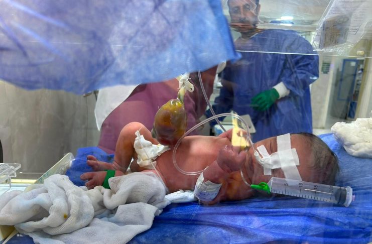 صحة الشرقية: إجراء جراحة متقدمة لطفل عمره يوم لإصلاح تشوه خلقي بالبطن بمستشفى القنايات المركزي